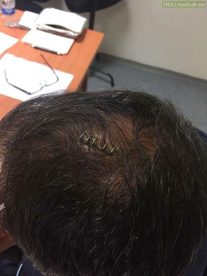 Besiktas manager Senol Gunes' stitched head after getting hit by a projectile during Fenerbahce - Besiktas