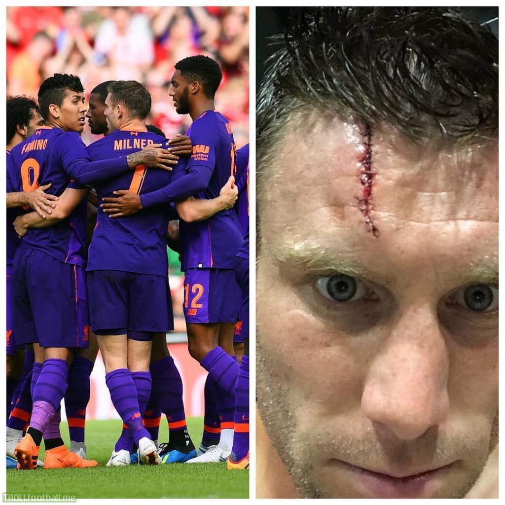 James Milner showed his stitched forhead in an Instagram post | Troll Football1024 x 1024