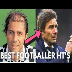 Best Footballer Hair Transplants