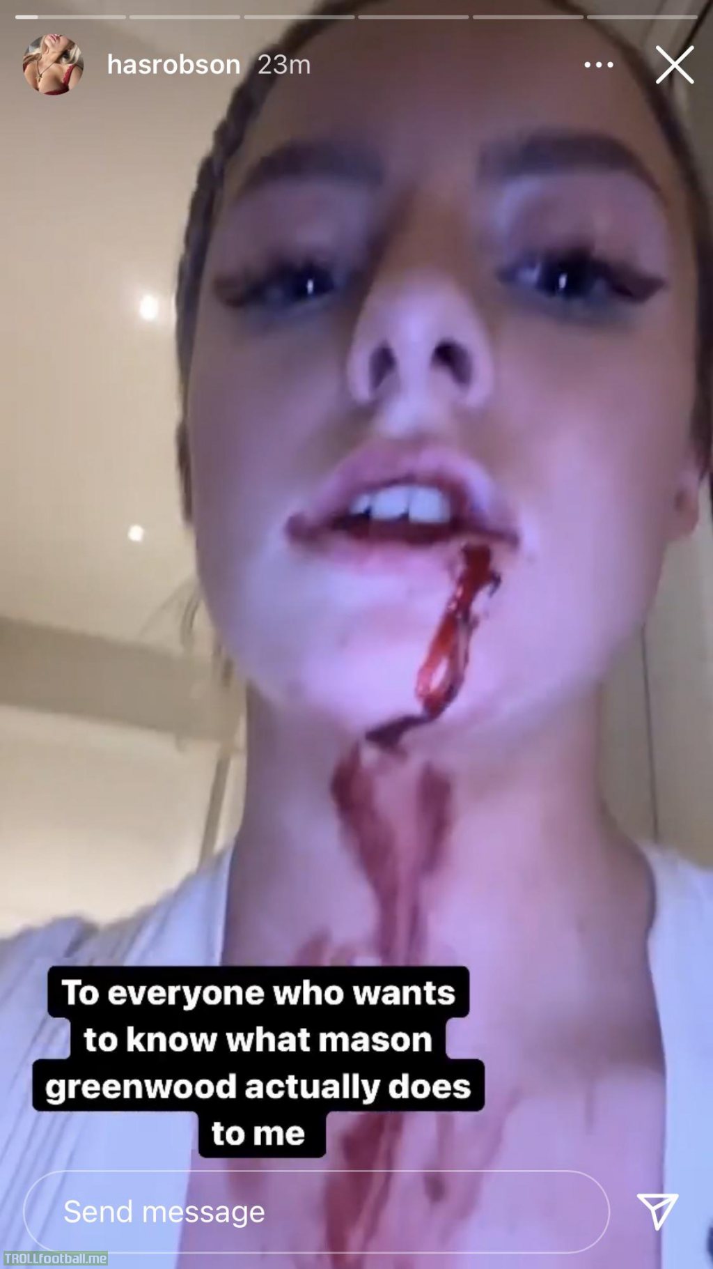 Mason Greenwood&#39;s partner Harriet Robson posted photos of her bleeding and  with bruises on her Instagram story and captioned it: “To everyone who  wants to know what Mason Greenwood actually does to