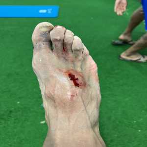 [Carlos Akapo] Photo showing what Hazard's foul (only a yellow) did to his right foot.