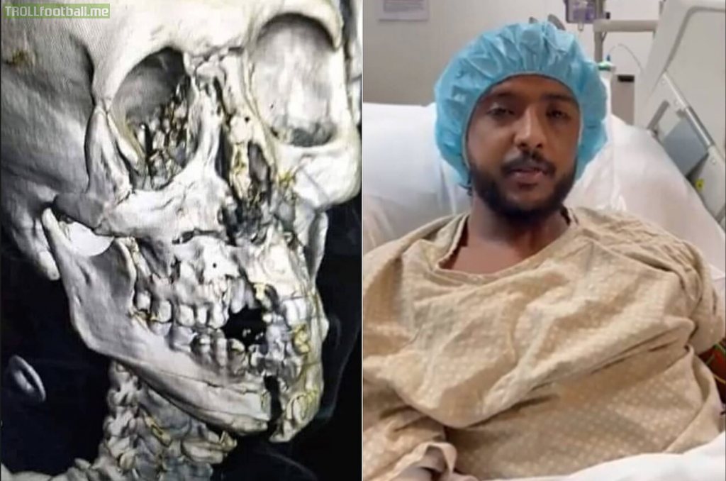 Al-Shahrani's skull after collision with his keeper (KSA v ARG)